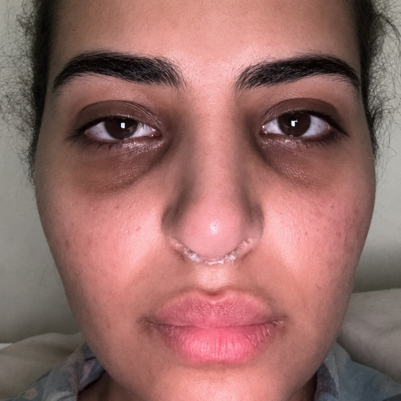 Renewed problem skin